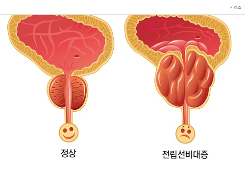 사진출처=강동경희대학교병원 비뇨의학과