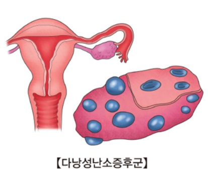 다낭성난소증후군, 이노시톨 효과 있을까