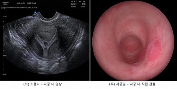 자궁경이라는 마지막 퍼즐